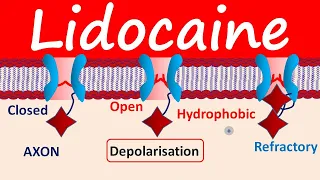 Lidocaine as Local Anesthetic