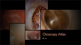 Otoscopy Atlas