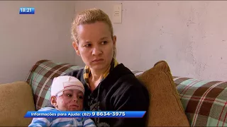 CA - Bebês queimados precisam de acompanhamento médico - 04-10-2017