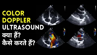 What is Color Doppler Ultrasound Test in Hindi? | Color Doppler Ultrasound Test Explained