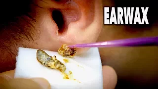 THE BEST EARWAX REMOVAL EVER!  (and most gross)  | Dr. Paul