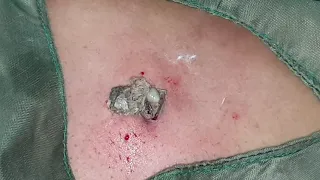 Excision of Sebaceous Cyst from back