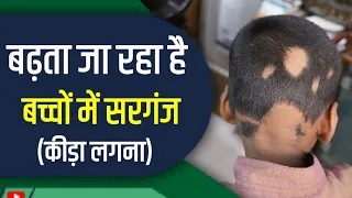 Live Trichoscopy of Alopecia Areata Patient (बालों में कीड़ा लगना) | Treatment of Patchy Hair Loss