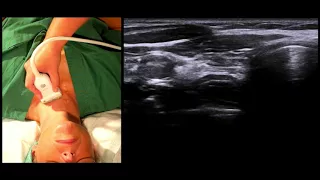 Airway Ultrasound