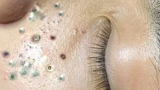 Blackheads removal! acne blackheads whiteheads removal8487