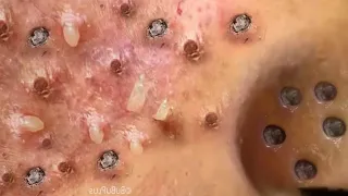 Loan Nguyen Acne spa 40