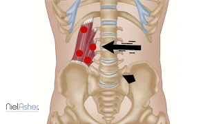 Quadratus Lumborum - Trigger Point Anatomy