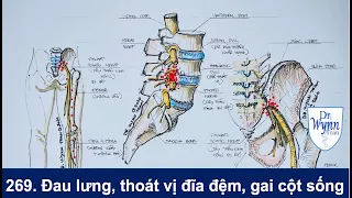 #269. Bệnh đau lưng, thoát vị đĩa đệm, và gai cột sống