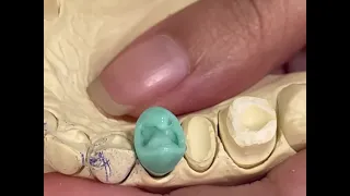 upper premolar waxup