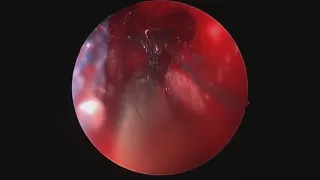 Hemorrhagic direct traumatic carotid-cavernous fistula during endoscopic transsphenoidal surgery ...