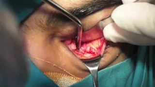 Orbital Blow out Fracture Repair