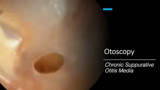 Chronic Suppurative Otitis Media: Otoscopy