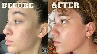 My Chemical Peel Experience | Arianna India