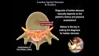 Lumbar Spinal Stenosis & Sciatica - Everything You Need To Know - Dr. Nabil Ebraheim