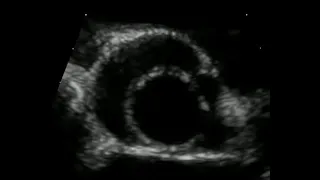 Unicuspid and Quadricuspid Aortic Valves