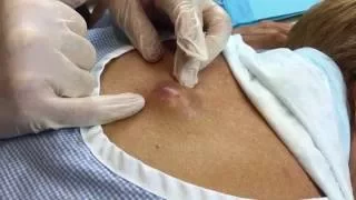 Infected Cyst on Mid-back