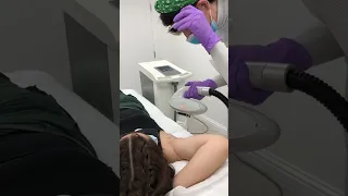 Medical Grade IPL Underarm Hair Removal