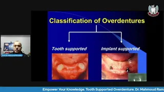 Tooth Supported Overdenture. Part 2: Classification, Abutment preparation & Attachments