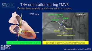 Dr. Adam Greenbaum Presents "Transcatheter Valve-in-valve And Ring-in-valve Replacement"