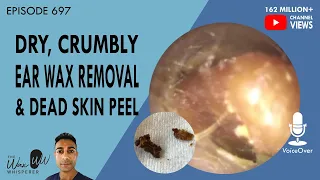 697 - Dry, Crumbly Ear Wax Removal & Dead Skin Peel