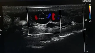 Reflux with Varicocele Ultrasound