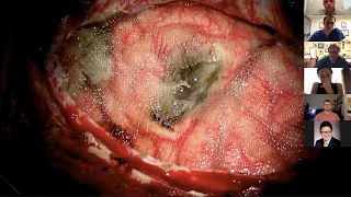 Medical Student Lecture Series - Cerebrovascular 1