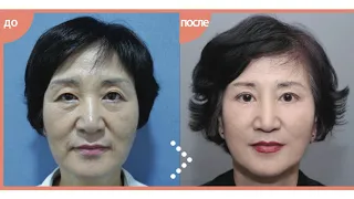 Methods of blepharoplasty, SMAS and MACS lifting with Dr. Oh Se Gwan [ENG Sub]