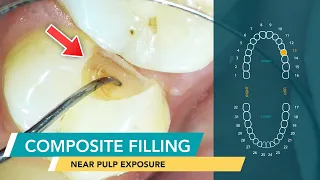 Composite Dental Filling | Fixing a Large Cavity