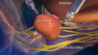 da Vinci Prostatectomy Patient Education Video