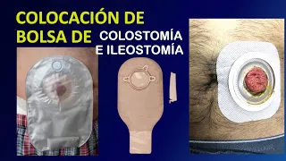 ✅ Como COLOCAR una 𝗕𝗢𝗟𝗦𝗔 de Colostomía o Ileostomía