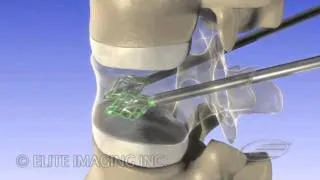 Vertebral Augmentation - Medical & Scientific Video Production