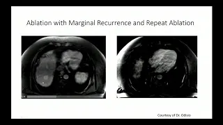 38. Liver Directed Therapy for HCC - Part 1. By Prof. Dr. Armeen Mahvash