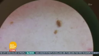 New Skin Cancer Treatment Now Available In England | Good Morning Britain