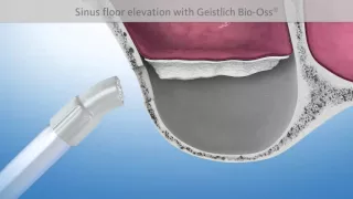 Sinus Lift Surgery For Dental Implants Budapest