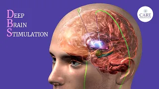 Deep Brain Stimulation Surgery Explained | How is DBS surgery done?