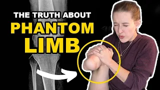 You Won’t Believe What Phantom Limb Pain is ACTUALLY Like [CC]