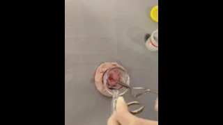 Removal of a Cervical Polyp