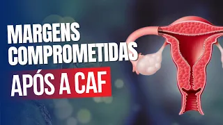 Margens comprometidas depois da CAF: qual a conduta?