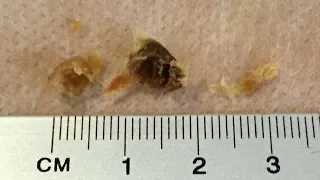 FALSE FUNDUS EAR WAX REMOVAL - #468