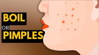 Boils vs. Pimples: What's the Difference and How to Treat Them