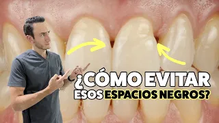 ¿Tienes triángulos/huecos negros entre tus dientes? ¡Esta puede ser tu solución!