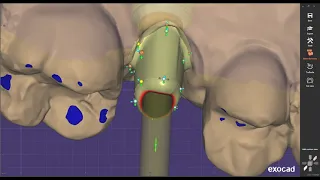 Exocad : How to design custom Abutment on Exocad