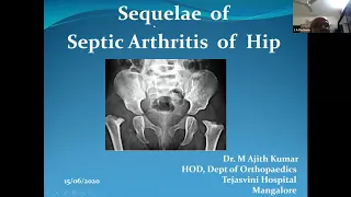 TO PASS DNB/MS ORTHOPAEDICS- CASE 94 - SEQUELAE OF SEPTIC ARTHRITIS OF HIP - BY DR. AJITH KUMAR