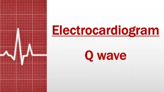 Q wave [Electrocardiogram]