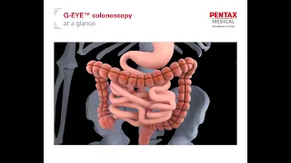 G EYE colonoscopy