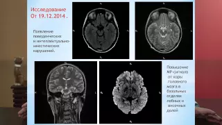 Тяжелое поражение головного мозга после приема курительной смеси (спайса). Союз педиатров России.