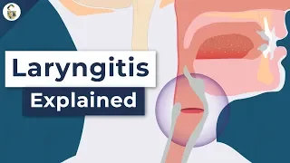 Why Do You Lose Your Voice? - Laryngitis Explained