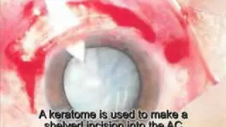 Technique of ECCE: Extra-Capsular Cataract Extraction