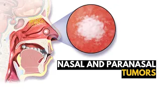 Nasal and Paranasal Tumors, Causes, Signs and Symptoms, Diagnosis and Treatment.