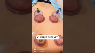 Cupping Therapy/ Hijama Therapy.